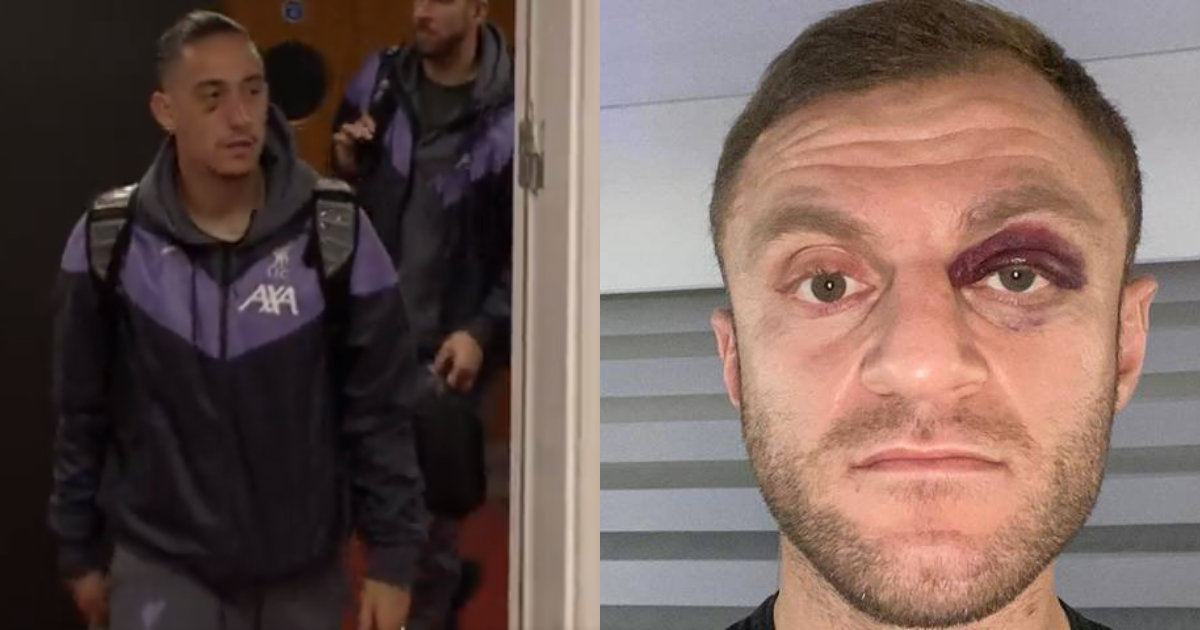 Τσιμίκας σκάει με μαυρισμένο μάτι σε αγώνα, μάλλον τσακώθηκε ο Οργισμένος Έλλην